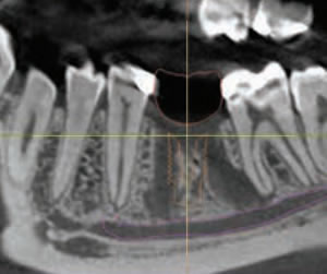 guided-dental-implants