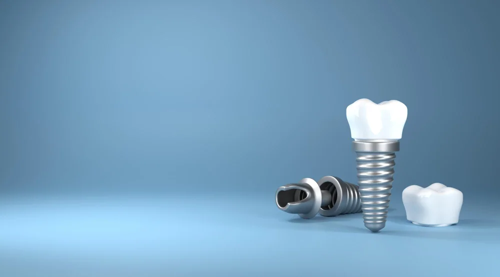 Dental Implants at Willow Dental Group