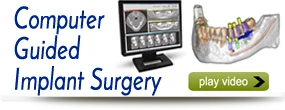 computer-guided-dental-implants