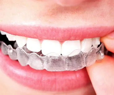 Maintaining Your Post-Invisible Aligner Smile