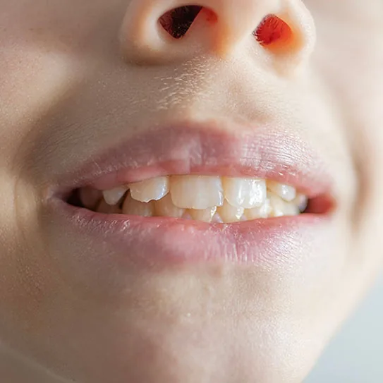 Gum Disease Can Affect Kids Too