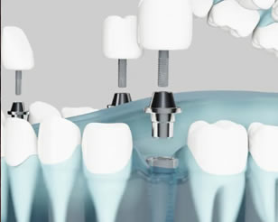 Computer Guided Dental Implants