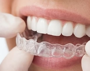 Invisalign 2