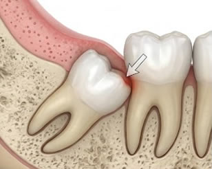 Wisdom Teeth Removal